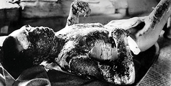 Japanese WW II Radiation Burn Victim 